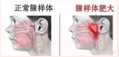 聊聊孩子「腺样体肥大」那些事儿 知乎