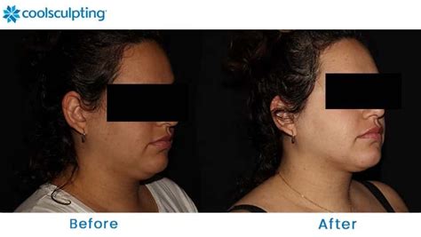 Coolsculpting Before And After Pictures Female Chin