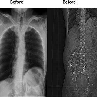 Spiral CT scan of abdomen and pelvic with contrast before and after... | Download Scientific Diagram