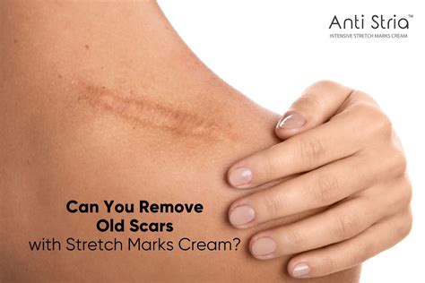 Do Anti Stria Stretch Marks Cream Works On Older Scar Tissues