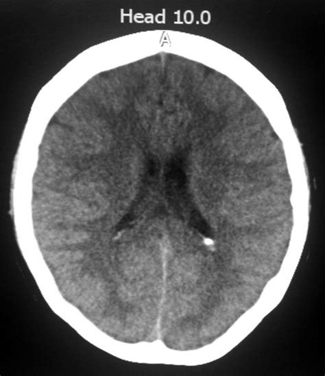 Tomografía Axial Computarizada De Cráneo Simple No Se Evidencian