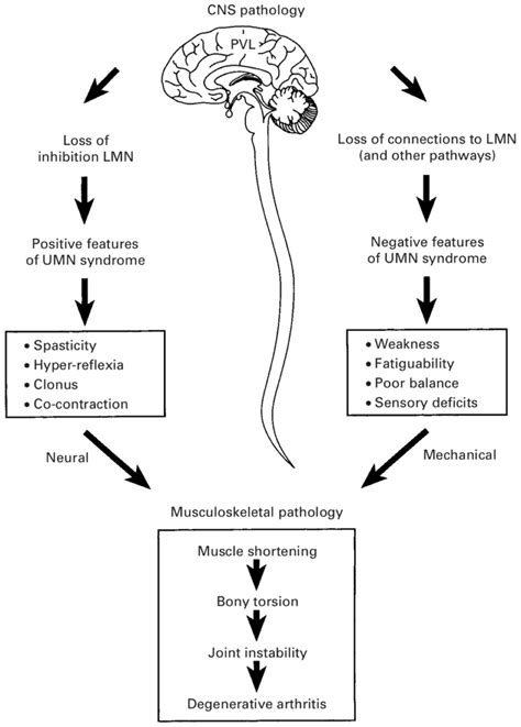 Why Do Upper Motor Neuron Lesions Cause Spasticity | Webmotor.org