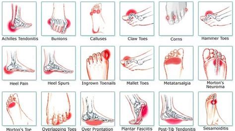 Foot Pain Location Chart