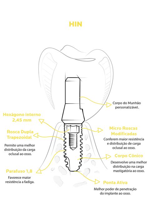 Hex Gono Interno Kopp Sistema De Implantes