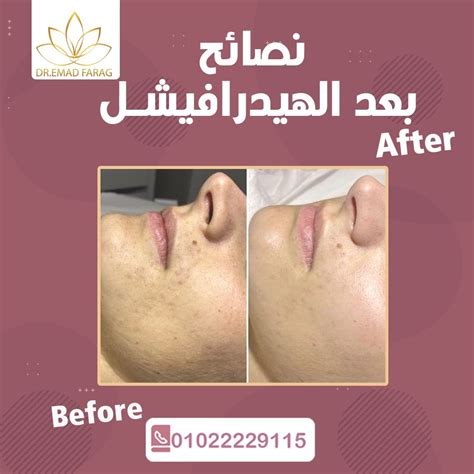 نصائح بعد الهيدرافيشل دكتور تجميل دكتور عماد فرج