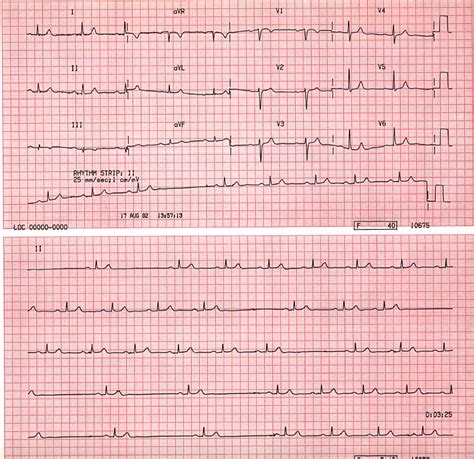 Case B3. Sino Atrial Block. St Emlyn's ECG Library