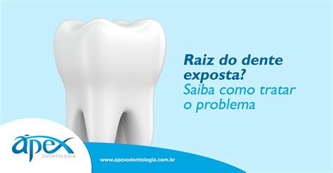 Raiz Do Dente Exposta Saiba Como Tratar O Problema Pex Odontologia