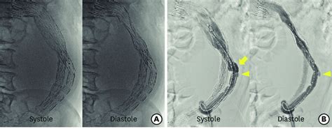 The Fluoroscopic And Aortographic Images A The Fluoroscopy Showed A