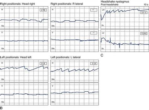 Vestibular and Balance Rehabilitation: Program Essentials | Ento Key