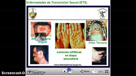 Las Enfermedades De Transmisión Sexual Ets Más Comunes Youtube