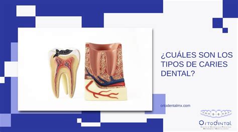 ¿cuáles Son Los Tipos De Caries Dental Ortodental