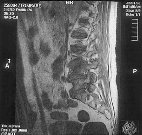 Figure 1 from Streptococcus bovis endocarditis and its association with ...