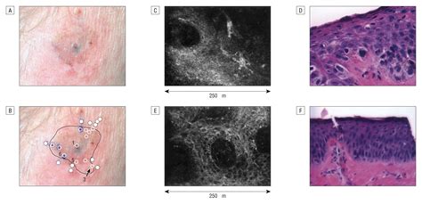 Use Of In Vivo Confocal Microscopy In Malignant Melanoma Dermatology