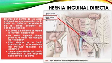 Hernias Inguinales Directas E Indirectas Femorales O Crurales Y Epi