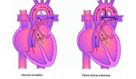 Ductus Arteriosus Persistens Dap Klinika Digjitale