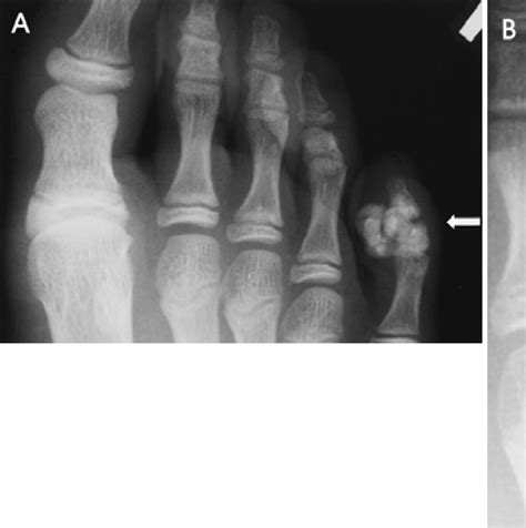 Figure From Tumoral Calcinosis Of The Foot Mri Histologic