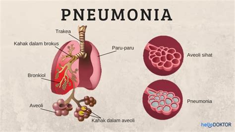 Komplikasi Pneumonia 6 Perkara Boleh Berlaku Pada Paru Paru Anda