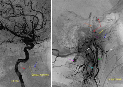 Ascending Palatine Artery Neuroangio Org