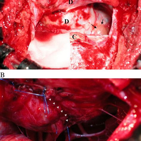 A Intraoperative Photography Shows Exposure Of The Dumbbellshaped