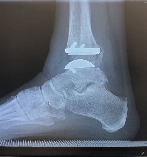 Decades of Pain Ended by Total Ankle Replacement: Tom’s Story