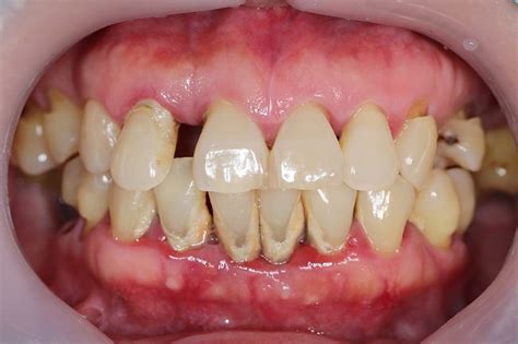 Diagnosis Periodontitis Alomedika