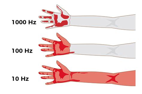 HAVS Malattia Da Vibrazioni Sindrome Da Vibrazioni Accademia