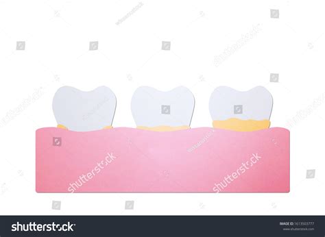 Step Plaque Tartar Cause Tooth Periodontal