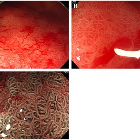 Esophagogastroduodenoscopy Showed Resolution Of The Patient’s Gastric Download Scientific