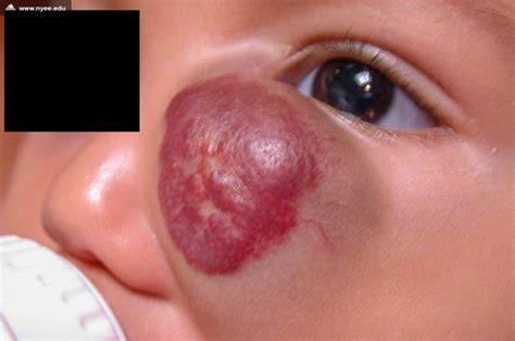 Capillary Hemangioma 3 Of 3 Nyee