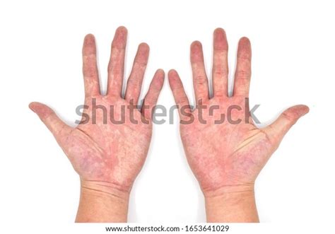 23 Palmar Erythema Images Stock Photos And Vectors Shutterstock