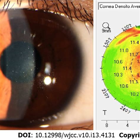 Slit Lamp Photograph Examination Of Grade 4 Diffuse Lamellar Keratitis Download Scientific