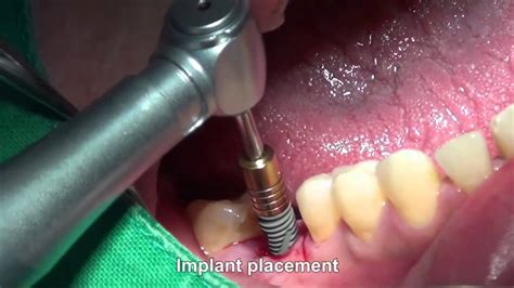 Mandibular Posterior Immediate Implant Placement With Open Membrane