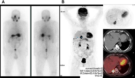 Pet Scan In Thyroid Cancer Pet Clinics