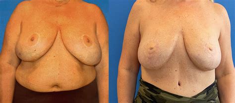 Breast Reconstruction Austin Tx Dr Weinfeld