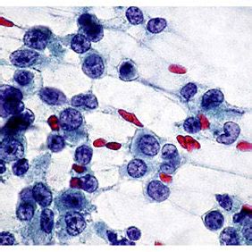 Tumor Cells With Round To Oval Vesicular Nuclei Nuclear Groove And