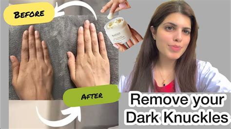 How To Remove Dark Knuckles Dark Knuckles Treatment With Only One Cream 💯 Results Dr