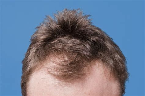 Dealing With Male Hair Loss Tips And Tricks The 2023 Guide To The