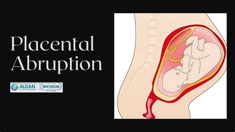 Placental Abruption [types Symptoms And Treatment]