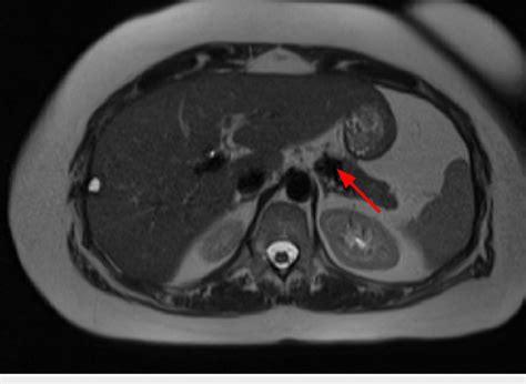 Mri Showing A T Hypointense Lesion Adjacent To The Pancreatic Body