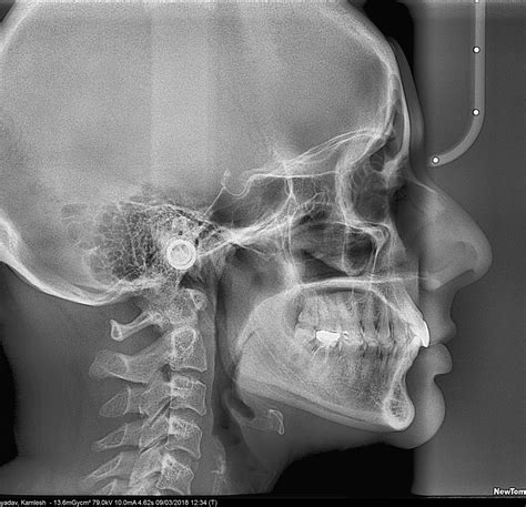 Lateral Ceph – Radiodent | Dental And Maxillofacial Imaging