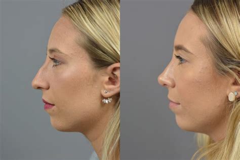 Nose Surgery Before After Patient 05 Dr Marotta