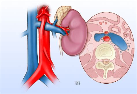 Renal Nutcracker Syndrome | Semantic Scholar