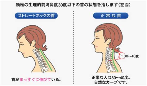 ストレートネック 施術について 京都市西京区【洛西口・桂川】の整体なら京都中丸整体カイロプラクティック