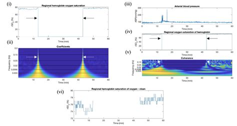 Wavelet Coefficient And Coherence Artifact Identification In Tbi Rso