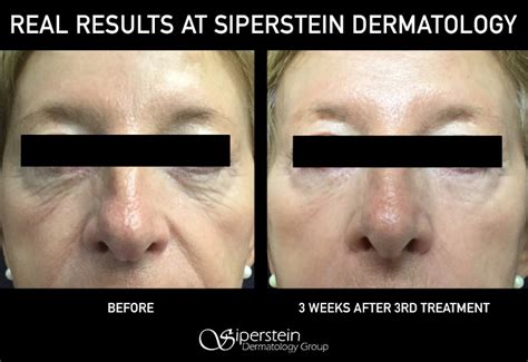 Secret Rf Microneedling Siperstein Dermatology Group