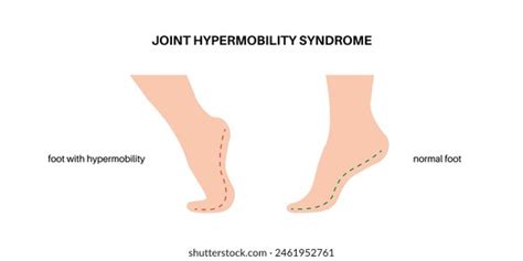 Joint Hypermobility Syndrome Hypermobility Spectrum Disorder Stock