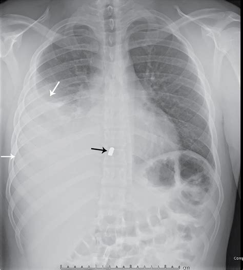 Chest Pains Pediatric Chest Trauma Clinical Tree