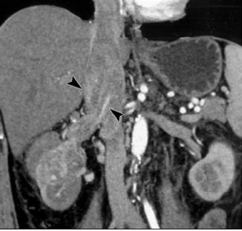 Figure From Tumors Invading The Inferior Vena Cava With Intracardiac