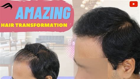 Hair Transplant In Mysore Best Results Cost And Surgeon Of Hair