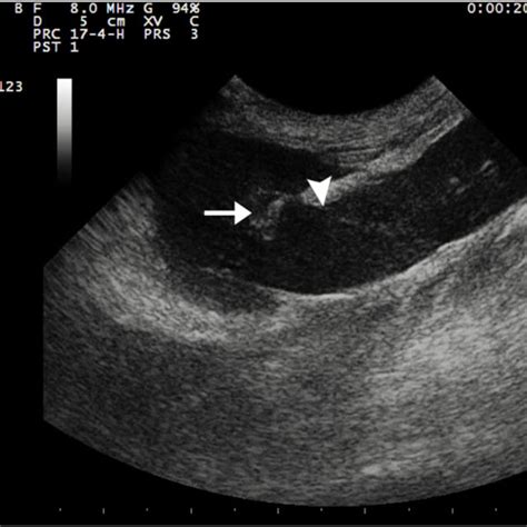 Ultrasound Image Of The Spleen In Longitudinal Section The Download Scientific Diagram